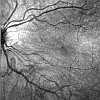OCT retinal image