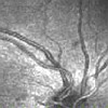 OCT image of optic nerve