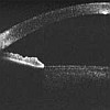 OCT scan of cornea